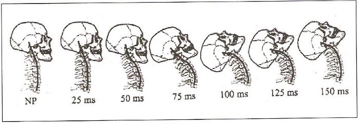 Latigazo cervical