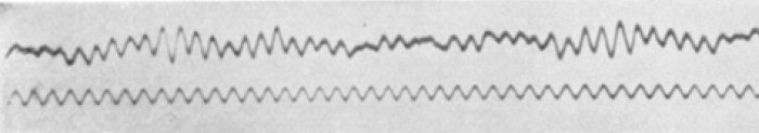 Uno de los primeros electroencefalogramas producidos por Hans Berger.
