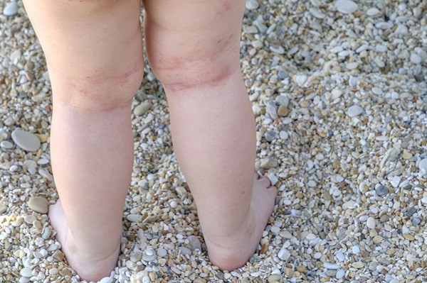 cuidado piel bebe verano cuidado piel bebe verano
